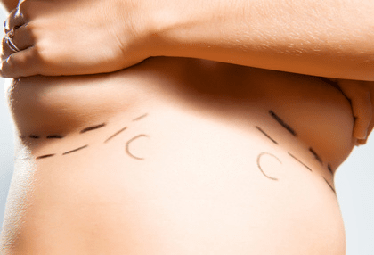 Réduction mammaire définition